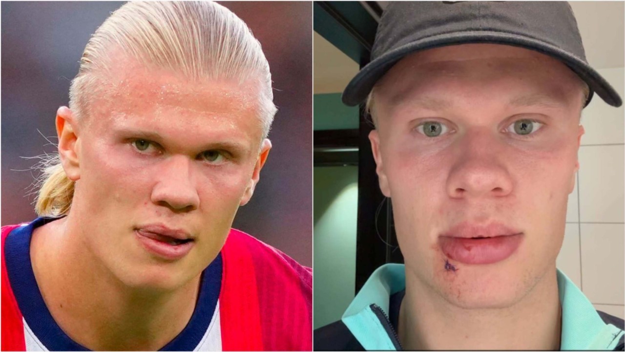Erling Haaland suffers freak facial injury on Norway team bus